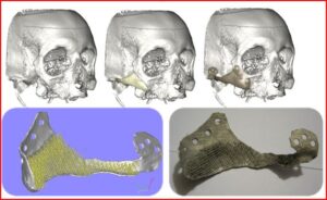 3D-Additive-Manufacturing-face-jaw bone-maxillary-bone